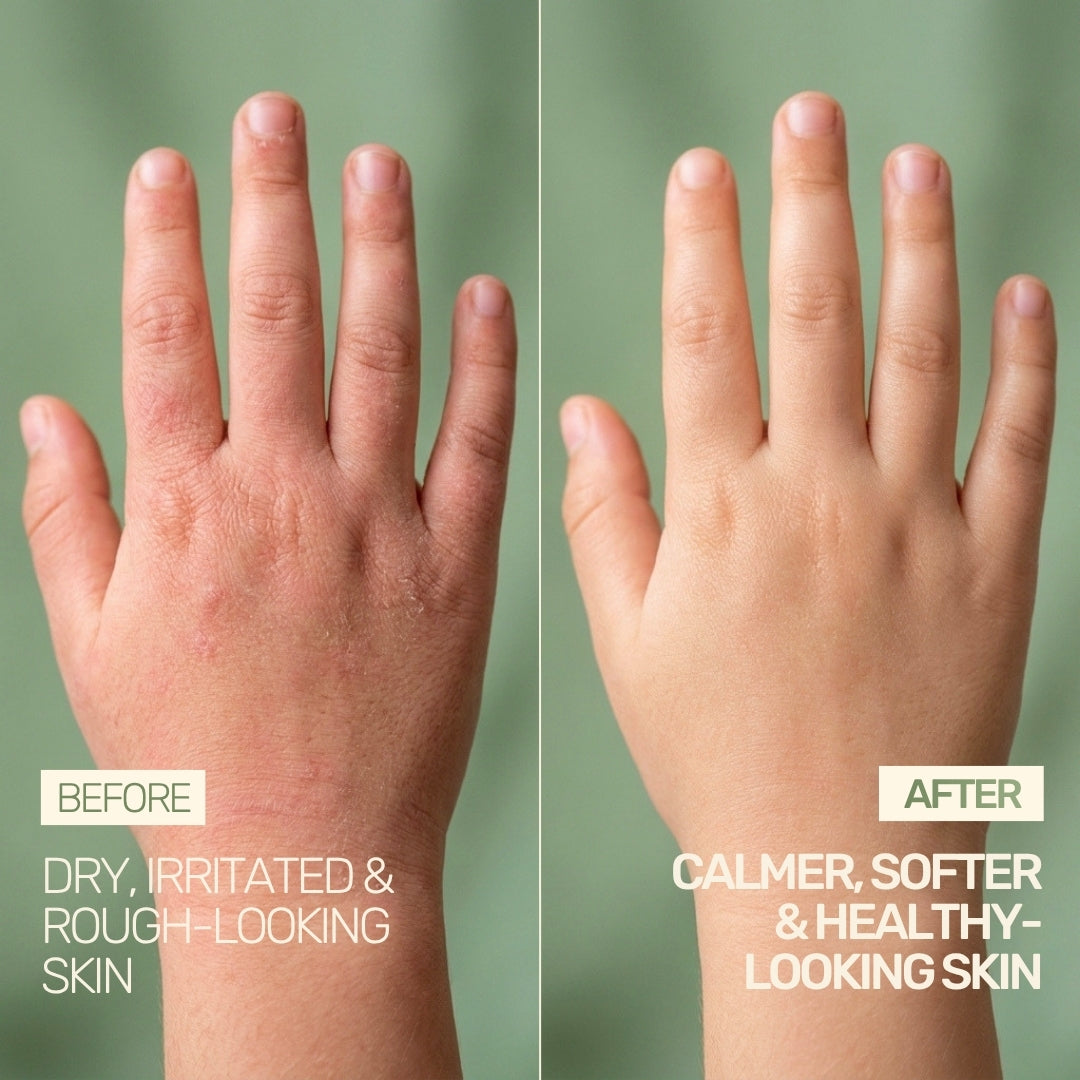 Before and after results using Kuppintaku Oil, transforming dry, irritated, rough skin into calmer, healthy-looking skin.